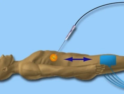 CIRURGIA POR RADIOFREQUÊNCIA